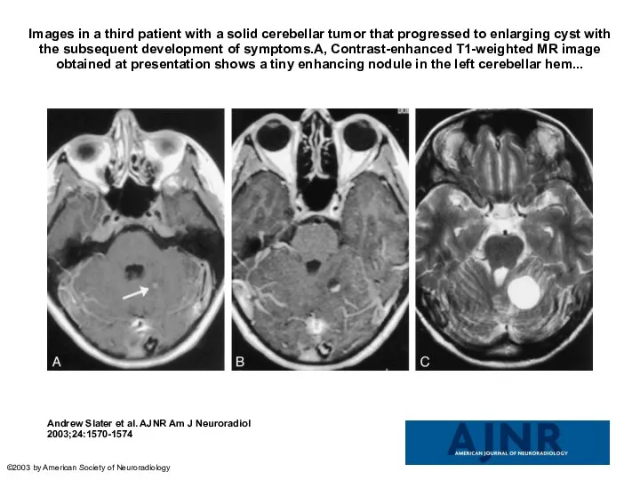 Images in a third patient with a solid cerebellar tumor that progressed