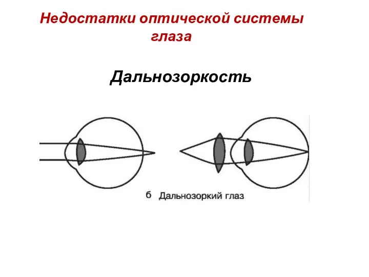 Недостатки оптической системы глаза Дальнозоркость