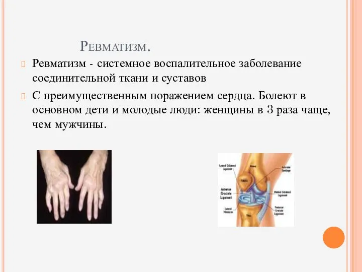 Ревматизм. Ревматизм - системное воспалительное заболевание соединительной ткани и суставов С преимущественным