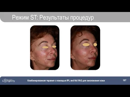 Комбинированная терапия с помощью IPL and Nd:YAG для омоложения кожи Режим ST: Результаты процедур
