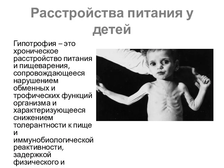 Расстройства питания у детей Гипотрофия – это хроническое расстройство питания и пищеварения,