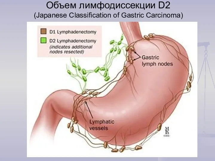 Объем лимфодиссекции D2 (Japanese Classification of Gastric Carcinoma)