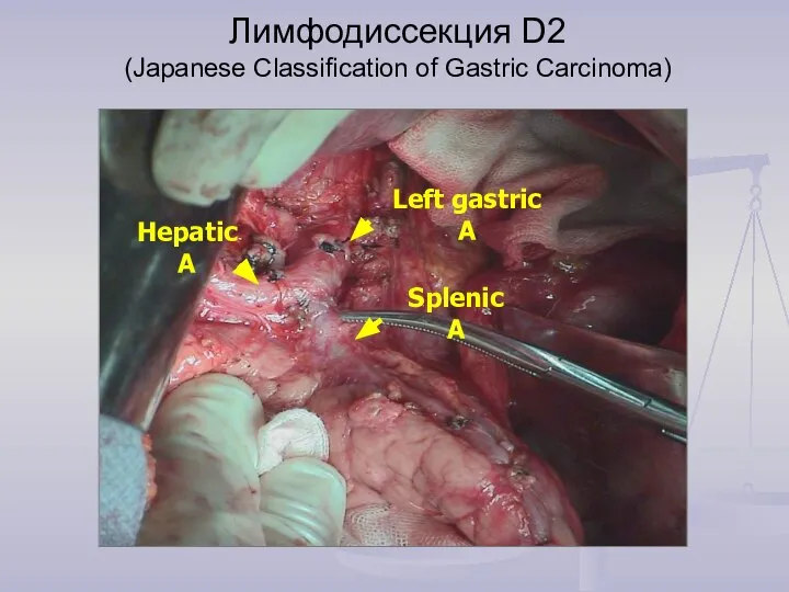 Лимфодиссекция D2 (Japanese Classification of Gastric Carcinoma)