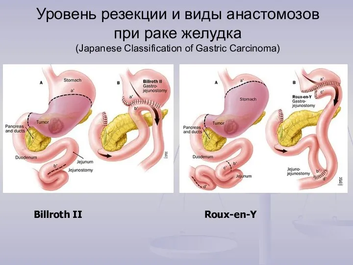 Уровень резекции и виды анастомозов при раке желудка (Japanese Classification of Gastric Carcinoma) Roux-en-Y Billroth II
