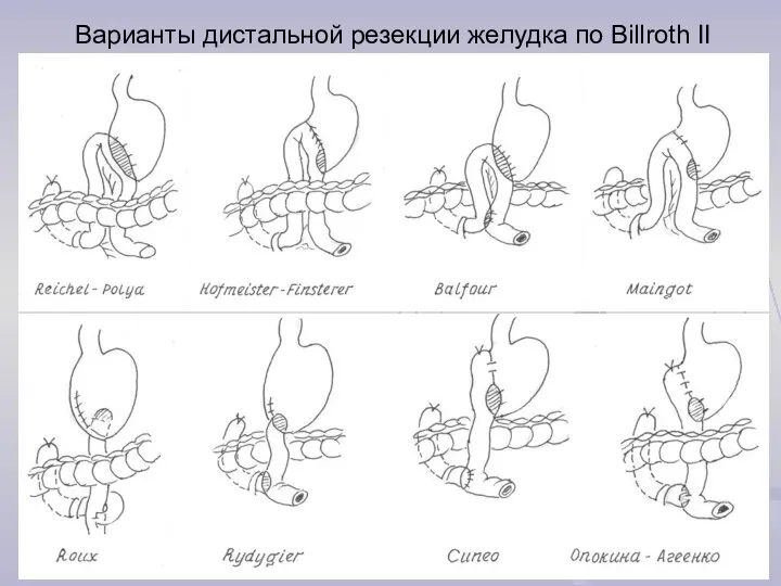 Варианты дистальной резекции желудка по Billroth II