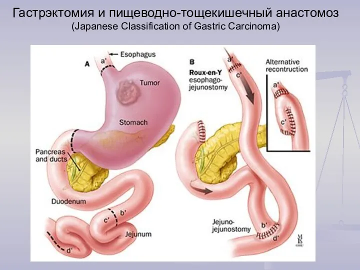 Гастрэктомия и пищеводно-тощекишечный анастомоз (Japanese Classification of Gastric Carcinoma)