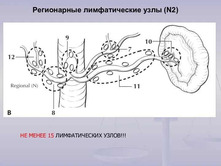 Регионарные лимфатические узлы (N2) НЕ МЕНЕЕ 15 ЛИМФАТИЧЕСКИХ УЗЛОВ!!!