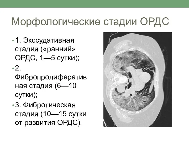 Морфологические стадии ОРДС 1. Экссудативная стадия («ранний» ОРДС, 1—5 сутки); 2.Фибропролиферативная стадия