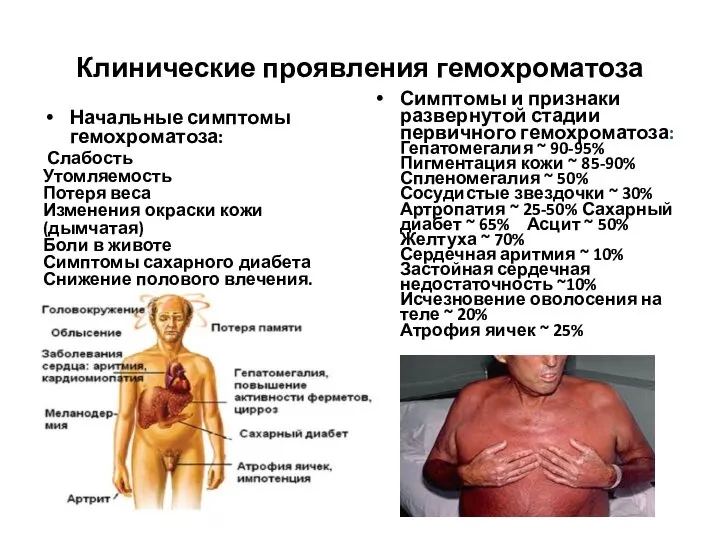 Клинические проявления гемохроматоза Начальные симптомы гемохроматоза: Слабость Утомляемость Потеря веса Изменения окраски