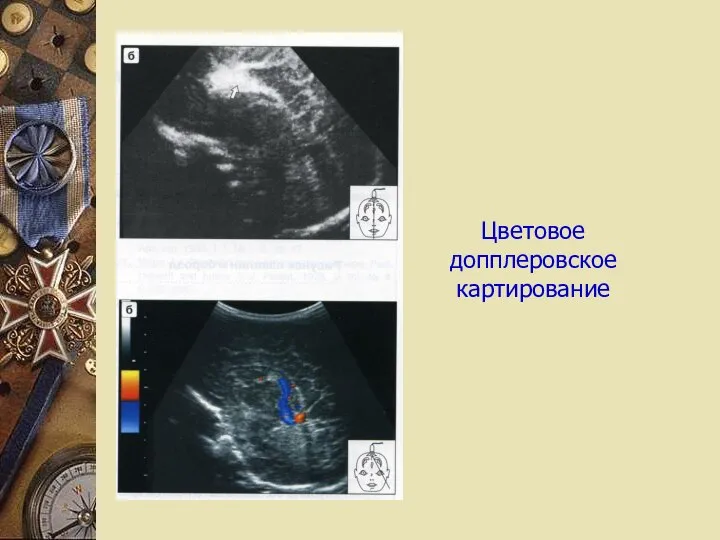 Цветовое допплеровское картирование