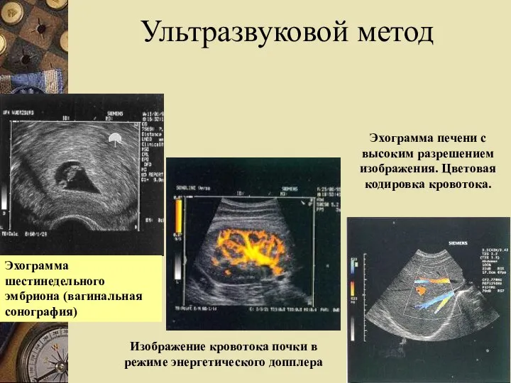 Ультразвуковой метод Эхограмма шестинедельного эмбриона (вагинальная сонография) Изображение кровотока почки в режиме