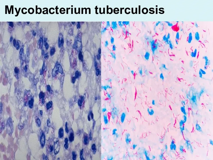 Mycobacterium tuberculosis