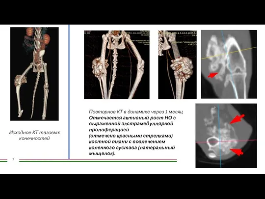 Исходное КТ тазовых конечностей Повторное КТ в динамике через 1 месяц Отмечается
