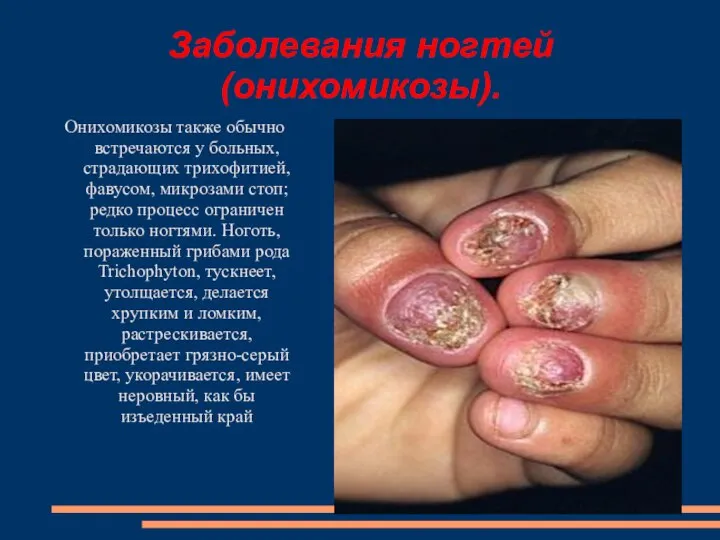 Заболевания ногтей (онихомикозы). Онихомикозы также обычно встречаются у больных, страдающих трихофитией, фавусом,