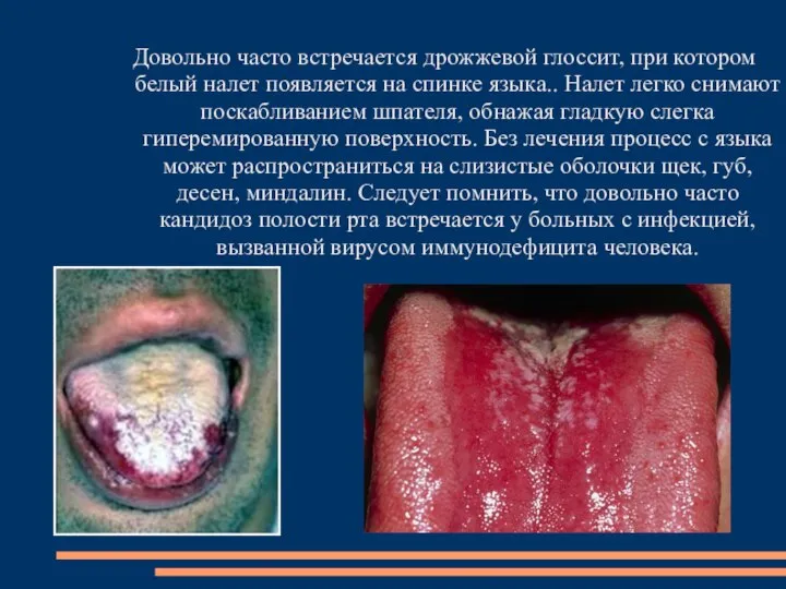 Довольно часто встречается дрожжевой глоссит, при котором белый налет появляется на спинке