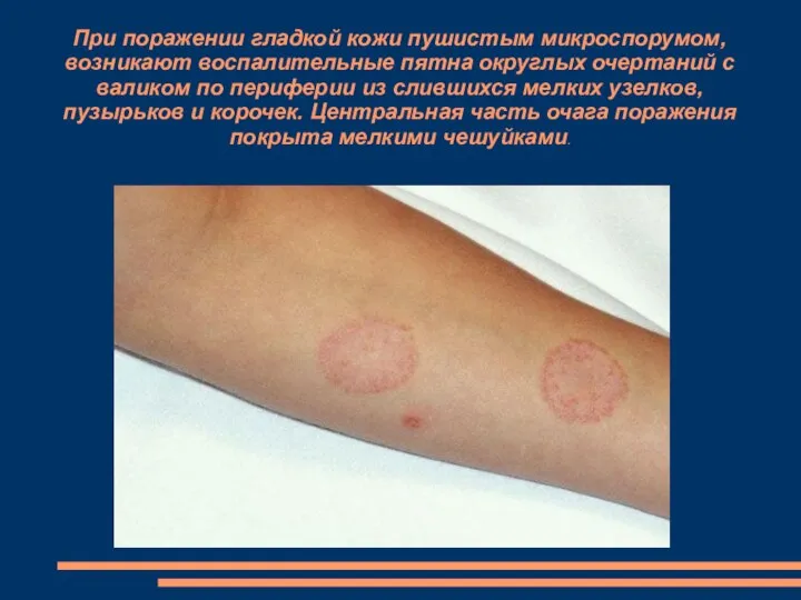 При поражении гладкой кожи пушистым микроспорумом, возникают воспалительные пятна округлых очертаний с
