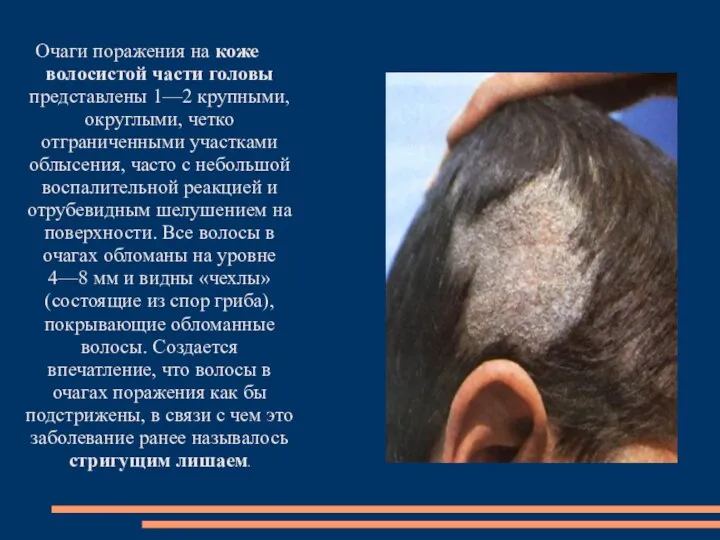 Очаги поражения на коже волосистой части головы представлены 1—2 крупными, округлыми, четко