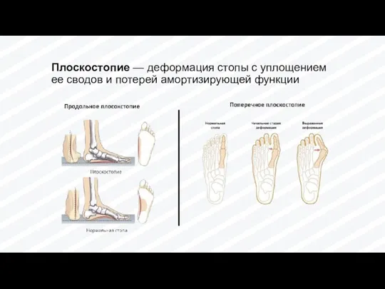 Плоскостопие — деформация стопы с уплощением ее сводов и потерей амортизирующей функции Хрусталик