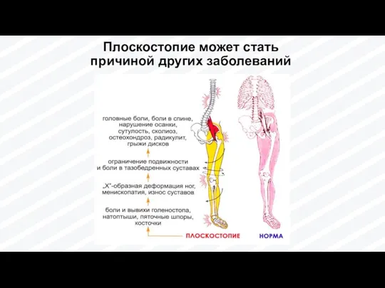 Плоскостопие может стать причиной других заболеваний