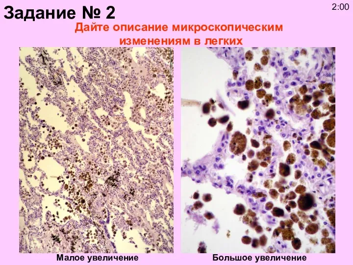 Дайте описание микроскопическим изменениям в легких Малое увеличение Большое увеличение Задание № 2 2:00