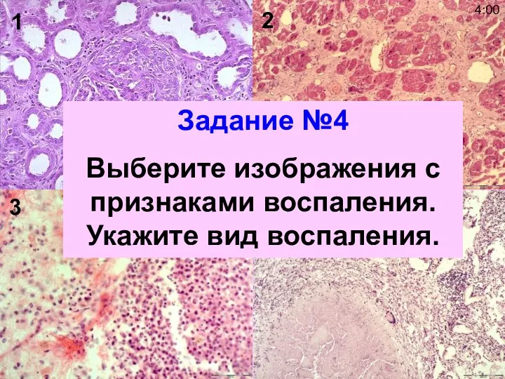 2 4 3 1 Задание №4 Выберите изображения с признаками воспаления. Укажите вид воспаления. 4:00