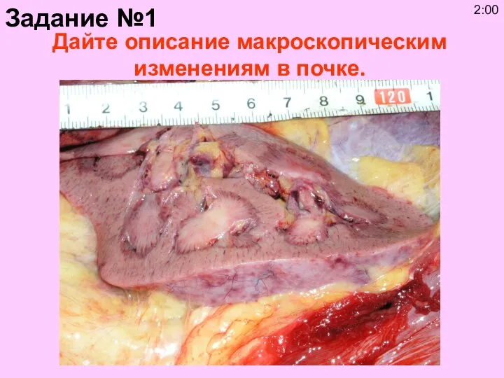 Дайте описание макроскопическим изменениям в почке. Задание №1 2:00