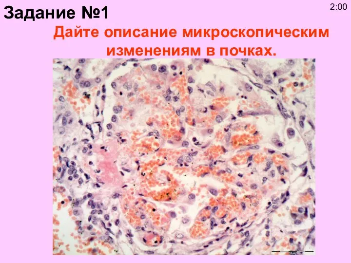 Дайте описание микроскопическим изменениям в почках. Задание №1 2:00