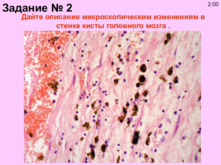 Дайте описание микроскопическим изменениям в стенке кисты головного мозга . Задание № 2 2:00