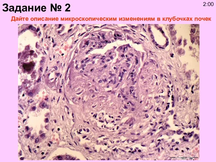 Дайте описание микроскопическим изменениям в клубочках почек Задание № 2 2:00