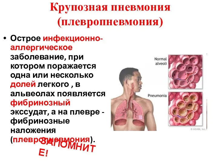 Крупозная пневмония (плевропневмония) Острое инфекционно-аллергическое заболевание, при котором поражается одна или несколько