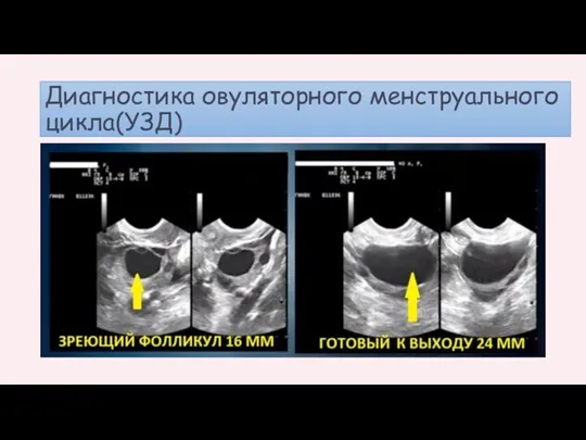 Диагностика овуляторного менструального цикла(УЗД)