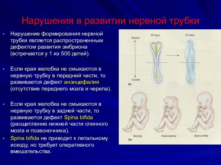 Нарушения в развитии нервной трубки Нарушение формирования нервной трубки является распространенным дефектом