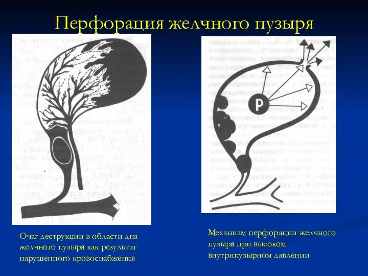 Перфорация желчного пузыря Очаг деструкции в области дна желчного пузыря как результат