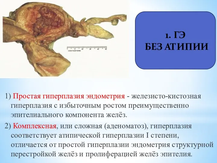 1) Простая гиперплазия эндометрия - железисто-кистозная гиперплазия с избыточным ростом преимущественно эпителиального