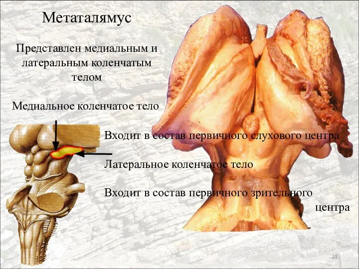 Метаталямус Представлен медиальным и латеральным коленчатым телом Медиальное коленчатое тело Входит в