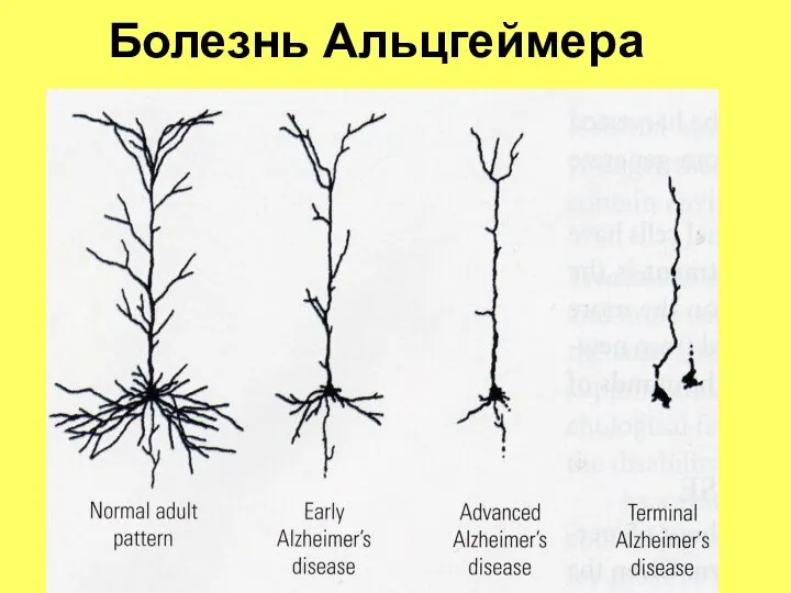 Болезнь Альцгеймера