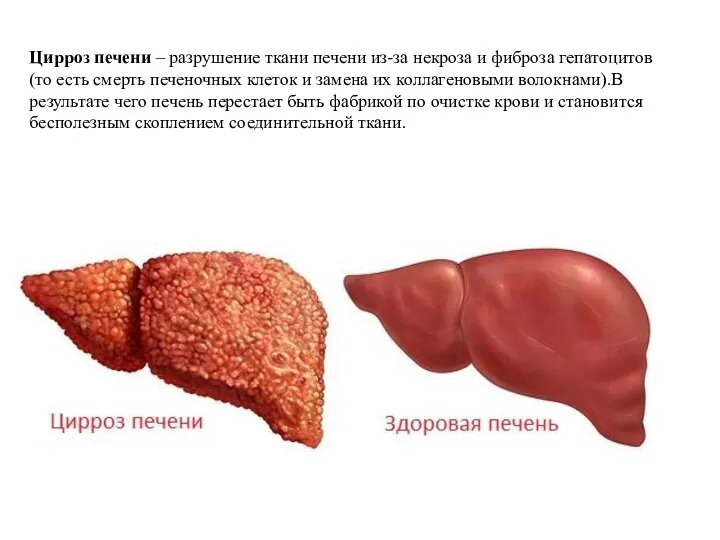 Цирроз печени – разрушение ткани печени из-за некроза и фиброза гепатоцитов (то