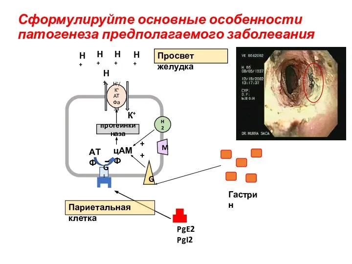 Сформулируйте основные особенности патогенеза предполагаемого заболевания Н+/К+ АТФаза Н+ К+ протеинкиназа Gi