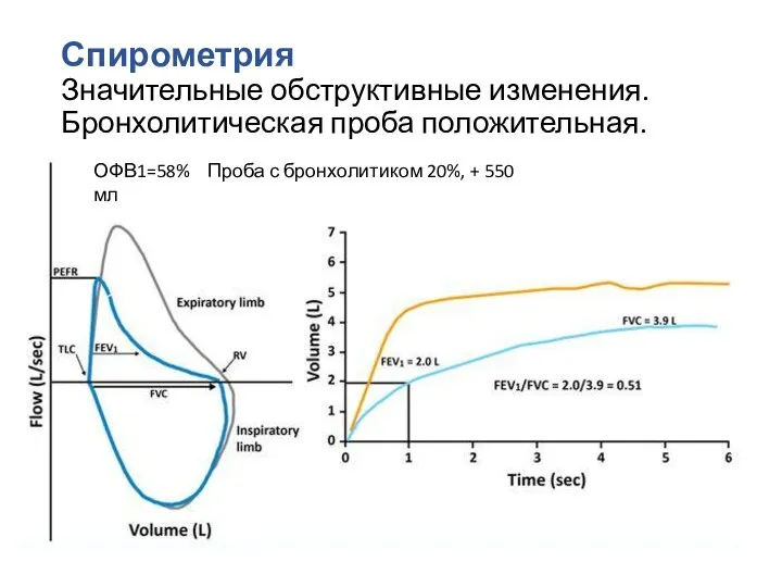 Спирометрия Значительные обструктивные изменения. Бронхолитическая проба положительная. ОФВ1=58% Проба с бронхолитиком 20%, + 550 мл