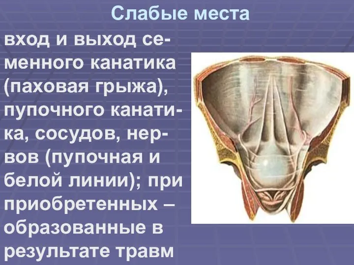 Слабые места вход и выход се-менного канатика (паховая грыжа), пупочного канати-ка, сосудов,