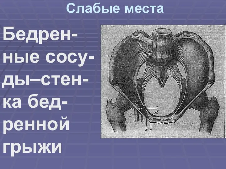 Слабые места Бедрен-ные сосу-ды–стен-ка бед-ренной грыжи