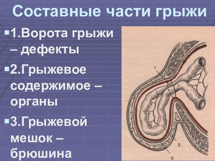 Составные части грыжи 1.Ворота грыжи – дефекты 2.Грыжевое содержимое – органы 3.Грыжевой мешок – брюшина