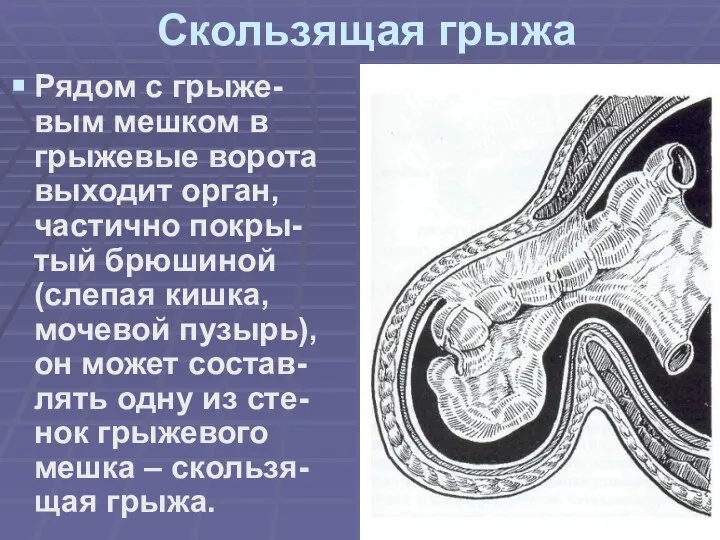 Скользящая грыжа Рядом с грыже-вым мешком в грыжевые ворота выходит орган, частично