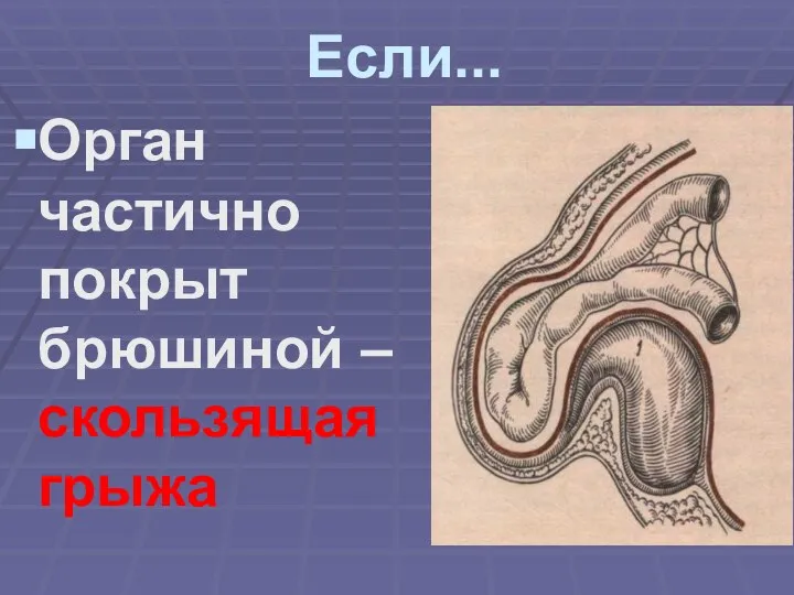 Если... Орган частично покрыт брюшиной – скользящая грыжа