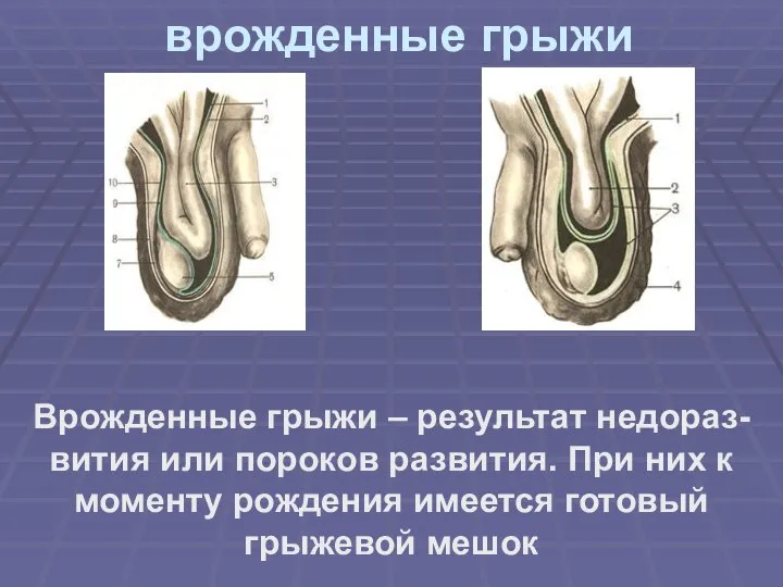 врожденные грыжи Врожденные грыжи – результат недораз-вития или пороков развития. При них