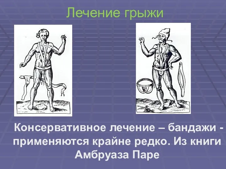 Лечение грыжи Консервативное лечение – бандажи - применяются крайне редко. Из книги Амбруаза Паре