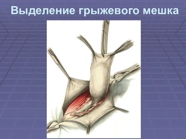 Выделение грыжевого мешка