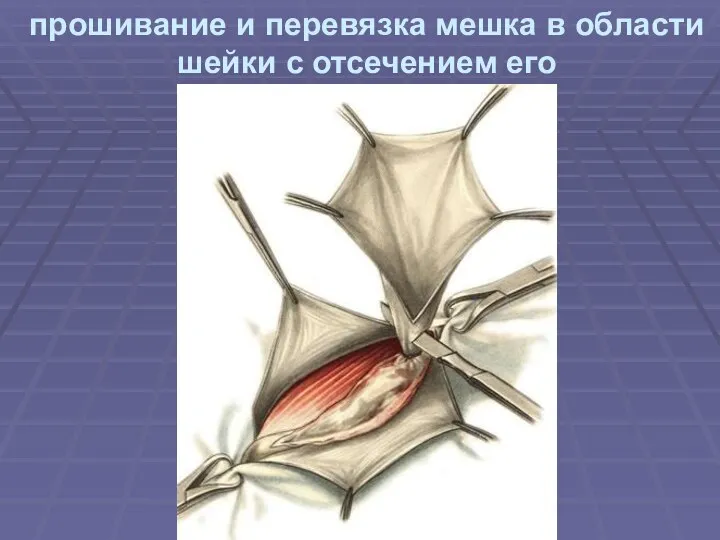 прошивание и перевязка мешка в области шейки с отсечением его