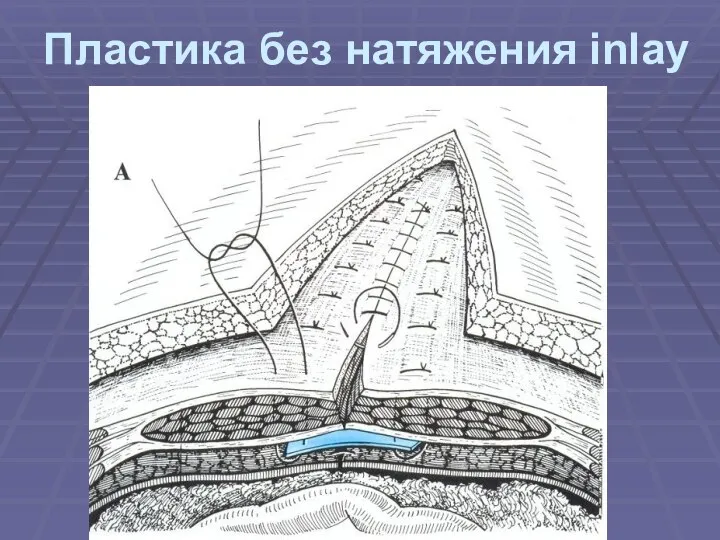 Пластика без натяжения inlay