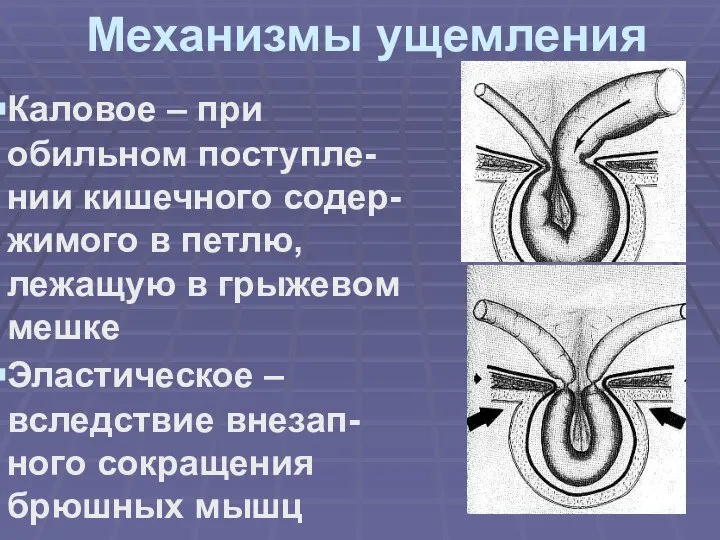 Механизмы ущемления Каловое – при обильном поступле-нии кишечного содер-жимого в петлю, лежащую